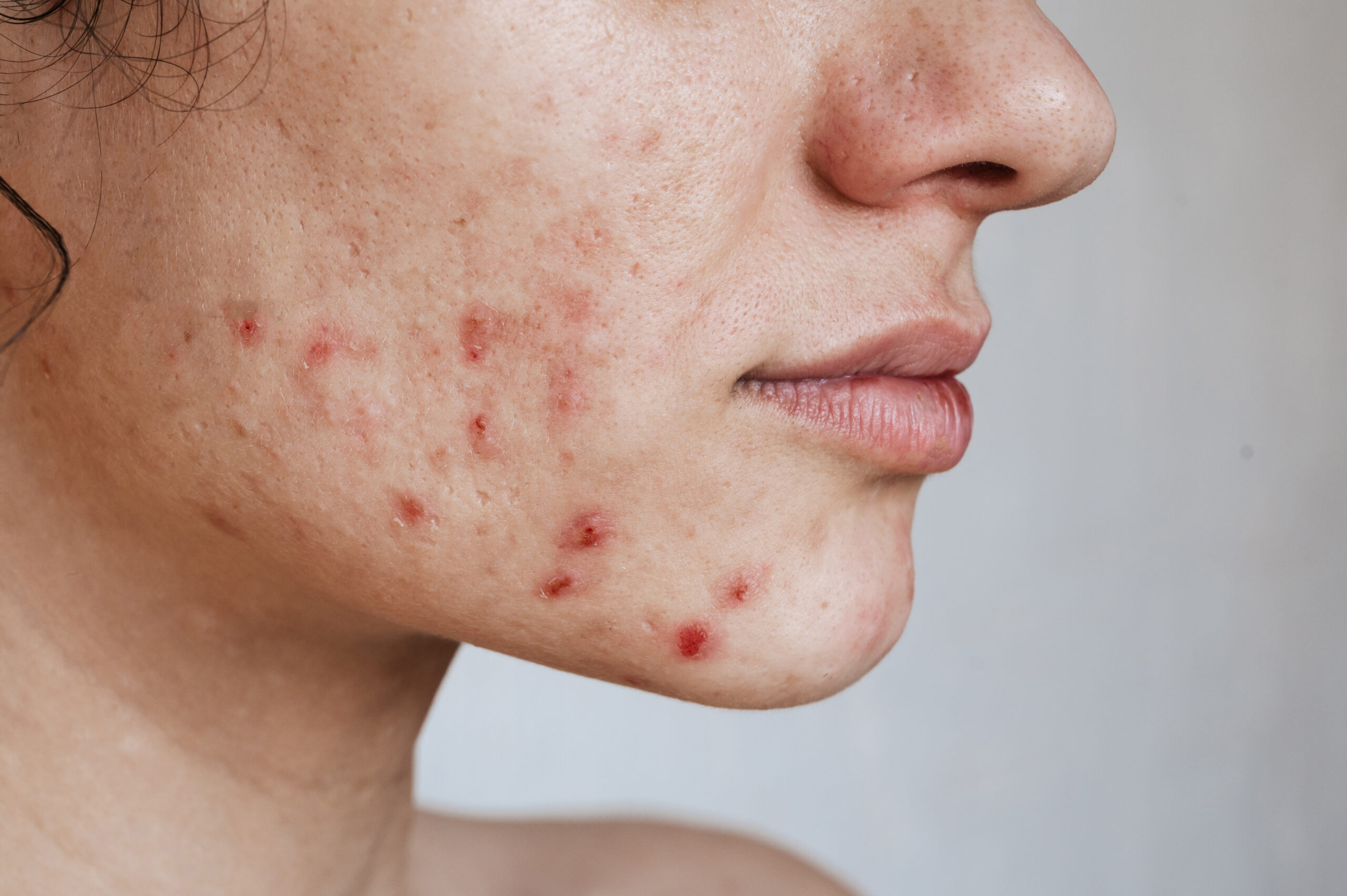 closeup skin young girl with problems pimples acne pores scars natural skin without filters scaled